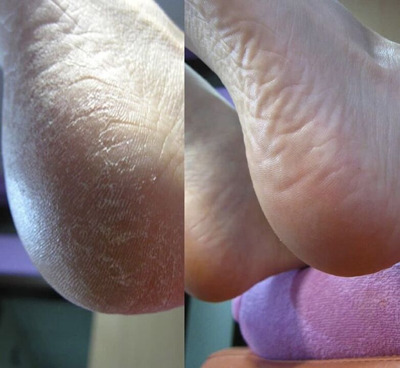 Fotó a láb sarkáról a Zenidol krém használata előtt és után