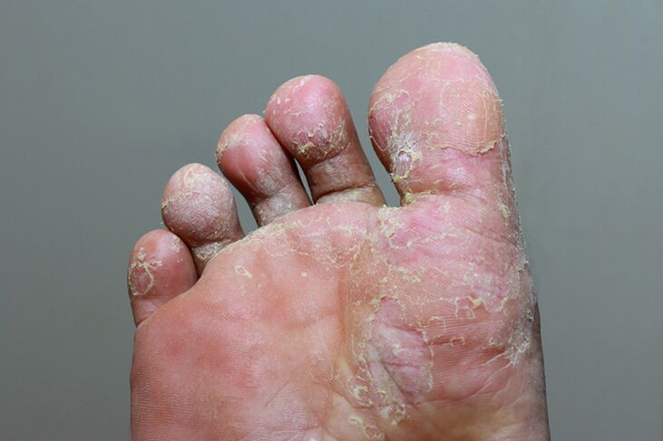 Az ujjbőr mycosis súlyos stádiuma