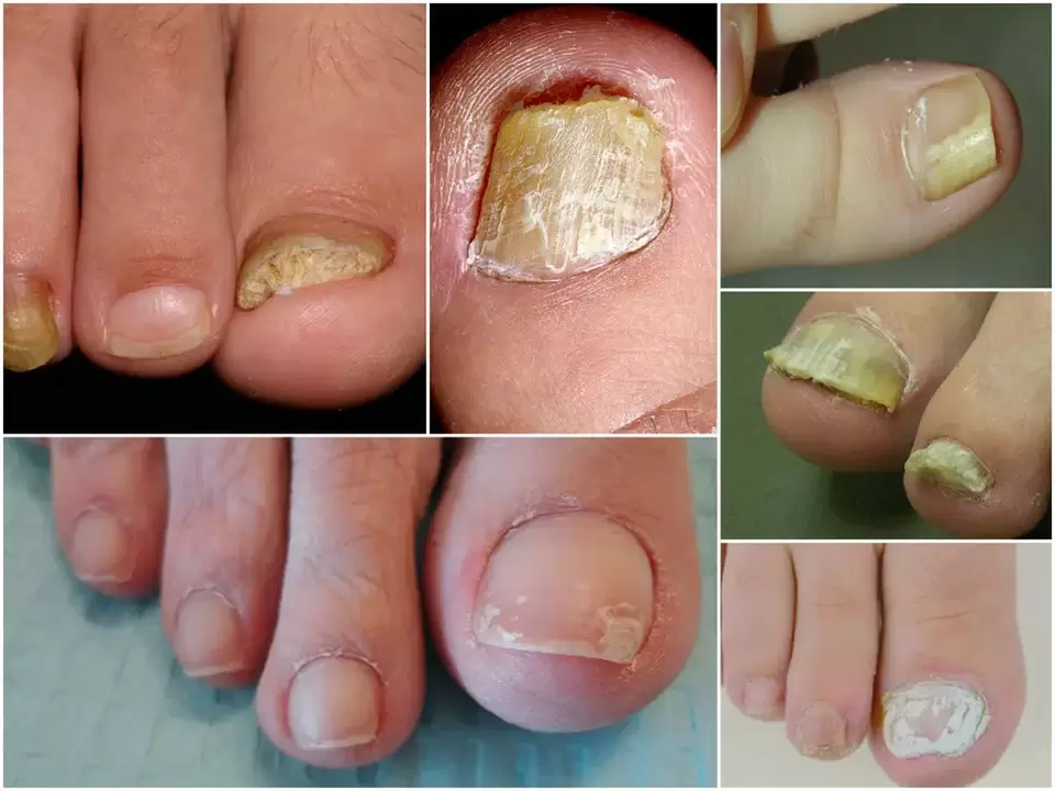 Az onychomycosis különböző formáinak megjelenése