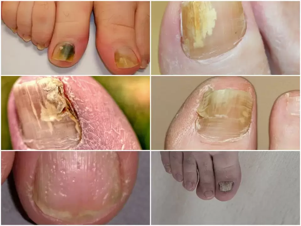 Az onychomycosis tünetei - a körmök színének és szerkezetének megváltozása