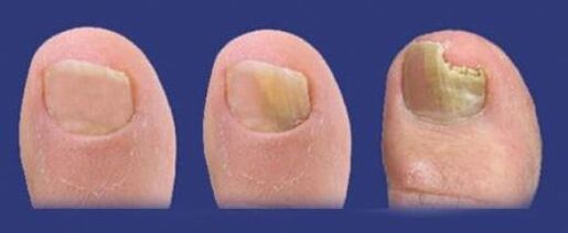 gomba toenails új gyógyszerek