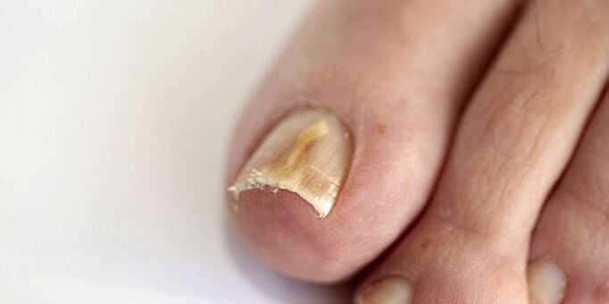 gomba toenails kezelés tabletták