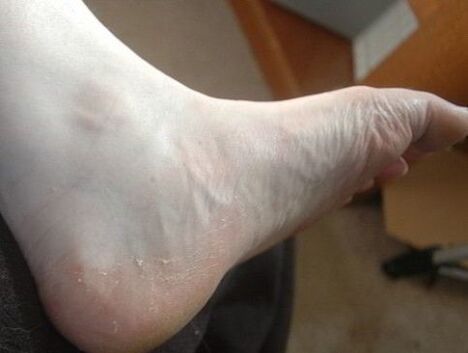 a lábfej hámlása a gombás fertőzés jele
