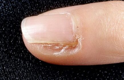 gombák nail betegség
