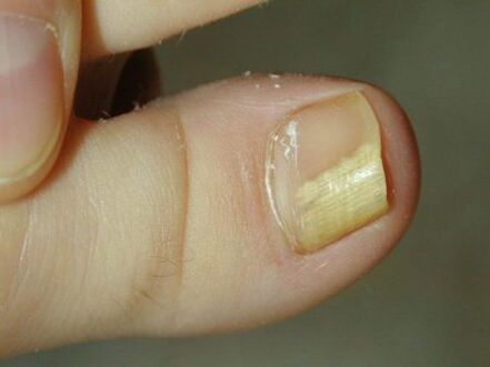 a kezelés nail gombák on legged form